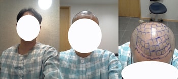 수술전