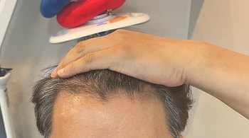 수술 1개월차 prp주사 맞은 후 셀카