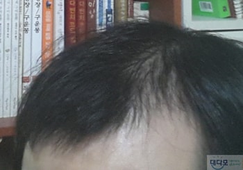 현재( 70여일/ 약바르고 떡진상태)