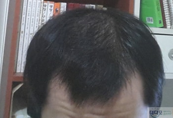 현재( 70여일/ 약바르고 떡진상태)