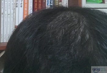 현재( 70여일/ 약바르고 떡진상태)
