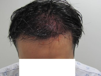 수술후 스프레이뿌리고 바로1