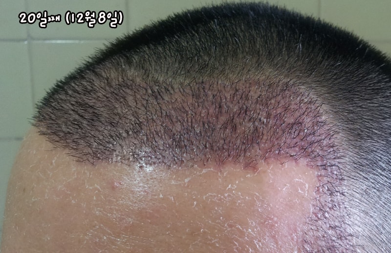 수술 20일째입니다.