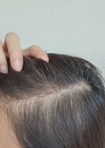 측두부쪽이 심해요