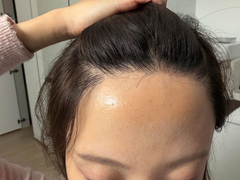 수술 후