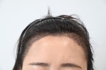 수술후