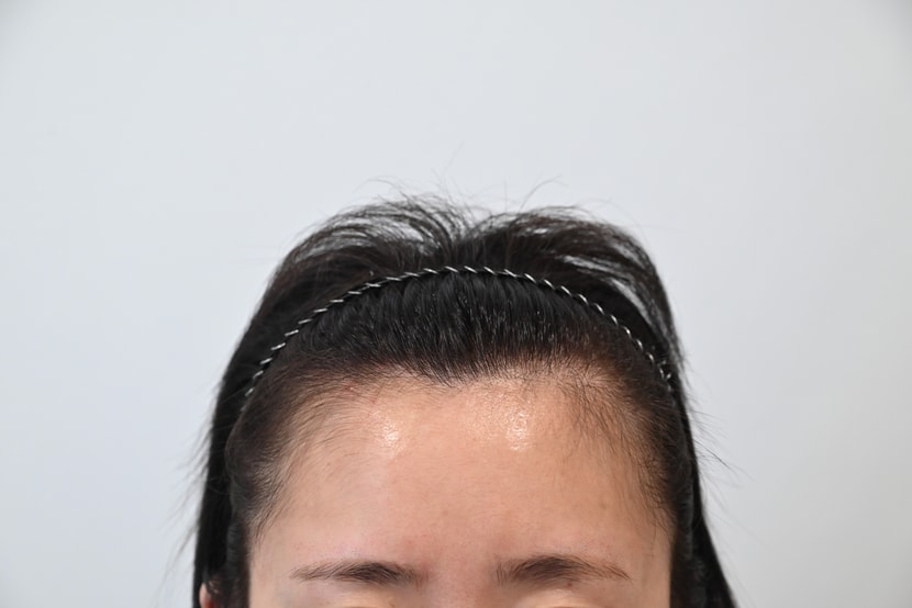 수술전