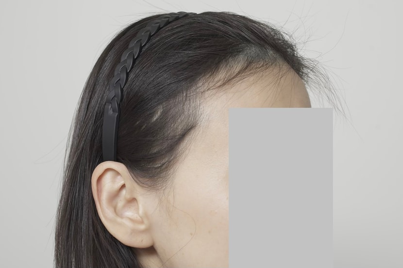이식 전 옆모습(여백 많음 주의)