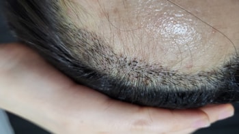 수술 일주일차