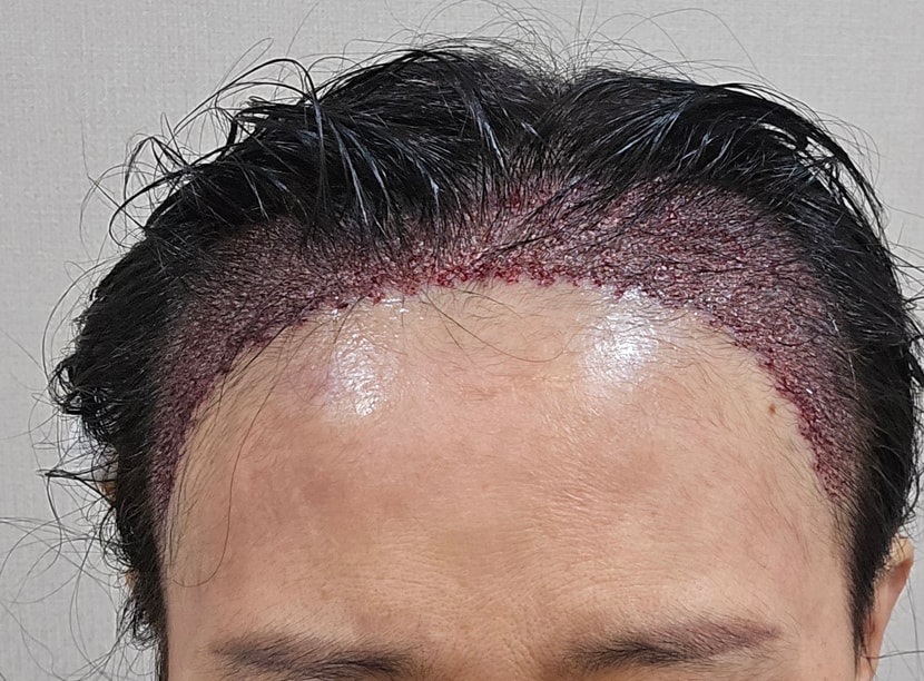 이식바로모습 이구요