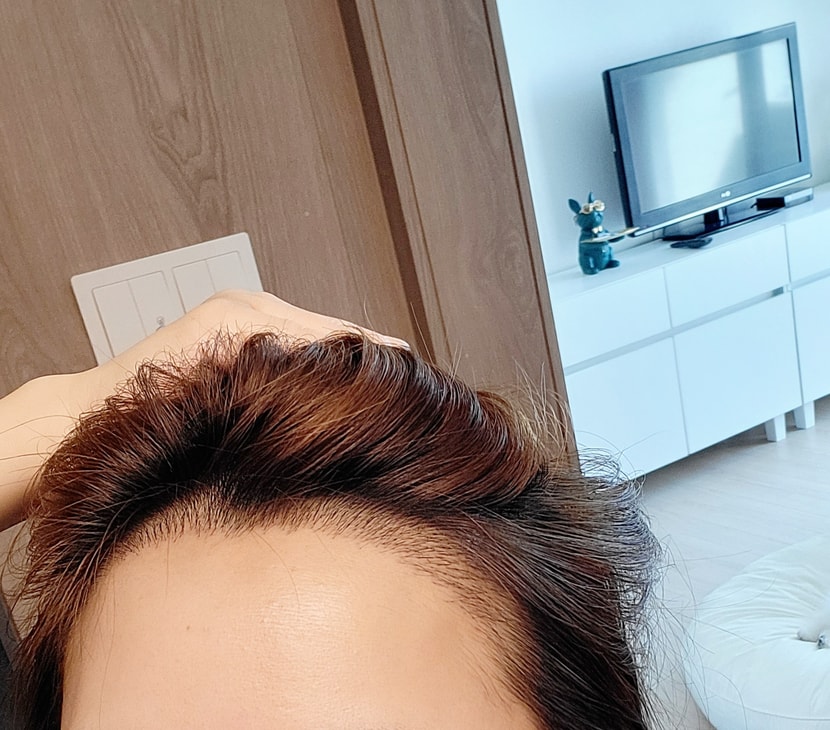 이식19일차 현재입니당