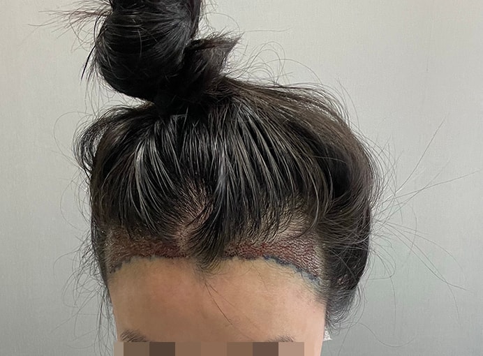 이식 끝나고 옷갈아입기 전에 찍어봤어요