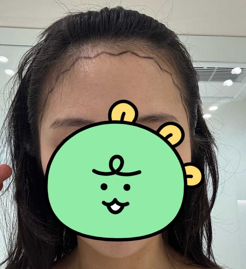 헤어라인