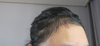 수술직후