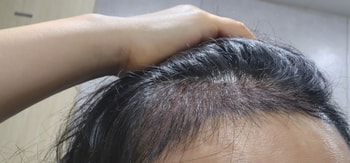 수술직후