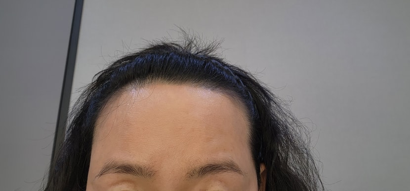 수술전