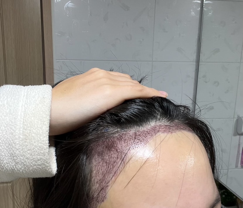 수술다음날
