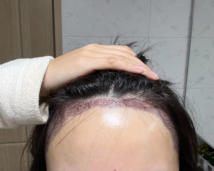 수술다음날
