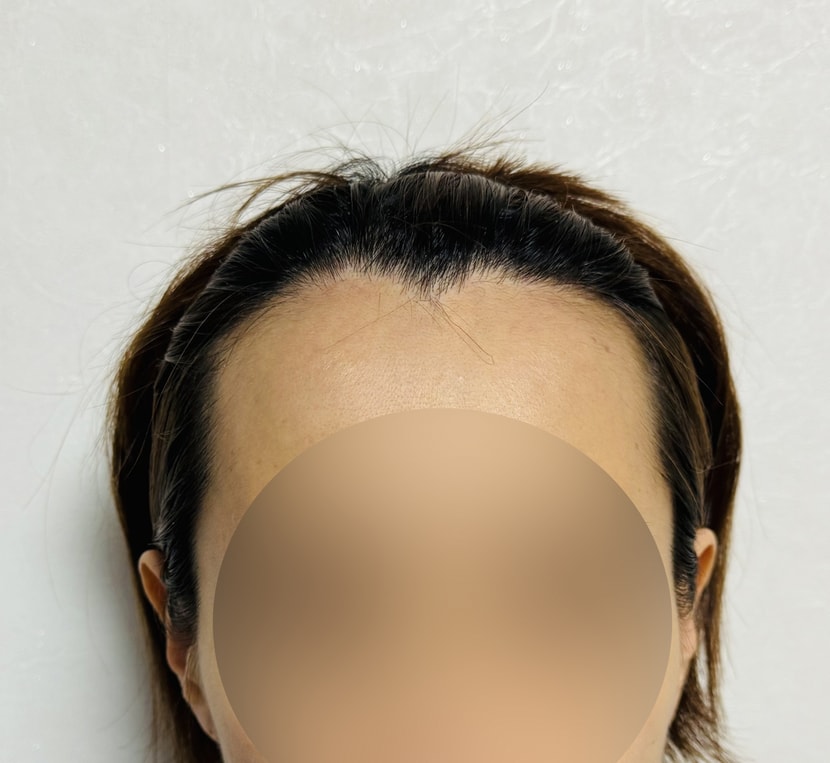 수술전