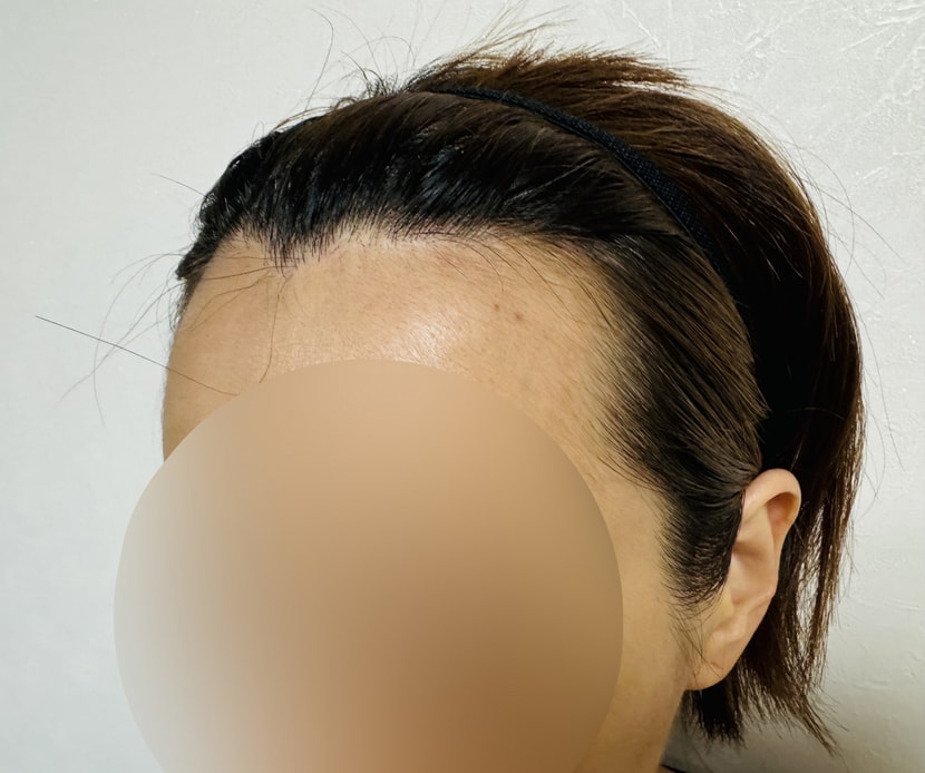 수술전