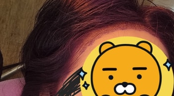 ﻿레이저 받으면서 찍은거예요 ﻿4일됐다고 조금 자란거 보이시나요? ﻿작고 소듕한 모낭들ㅎ