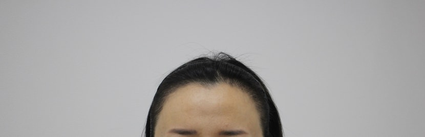 수술후한달