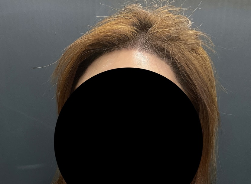 헤어라인 수술 후 현재