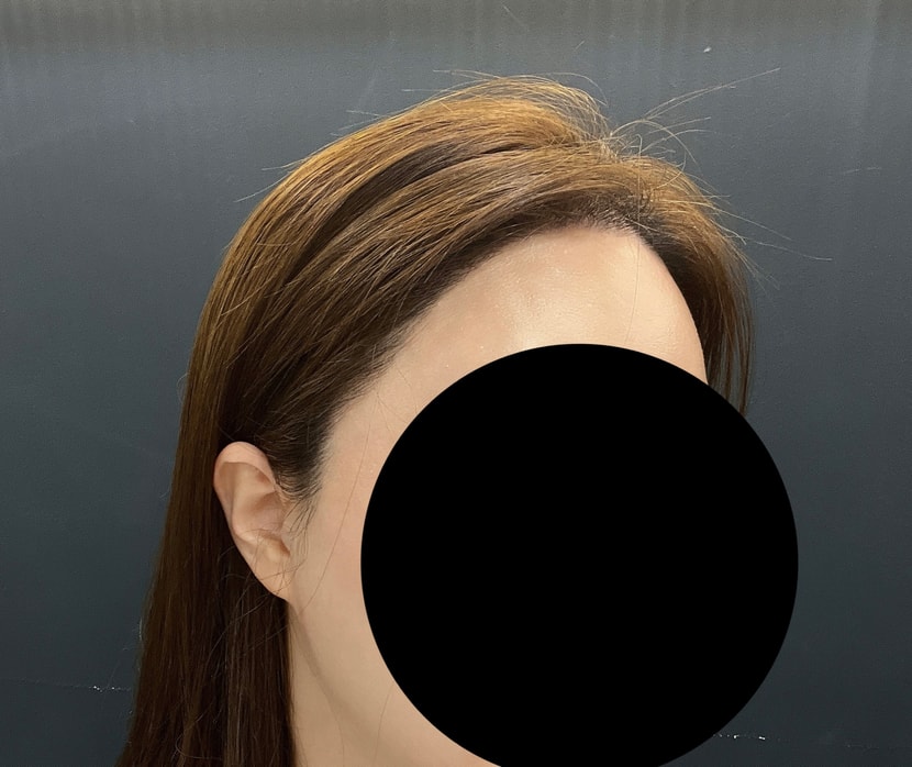 헤어라인 수술 후 현재