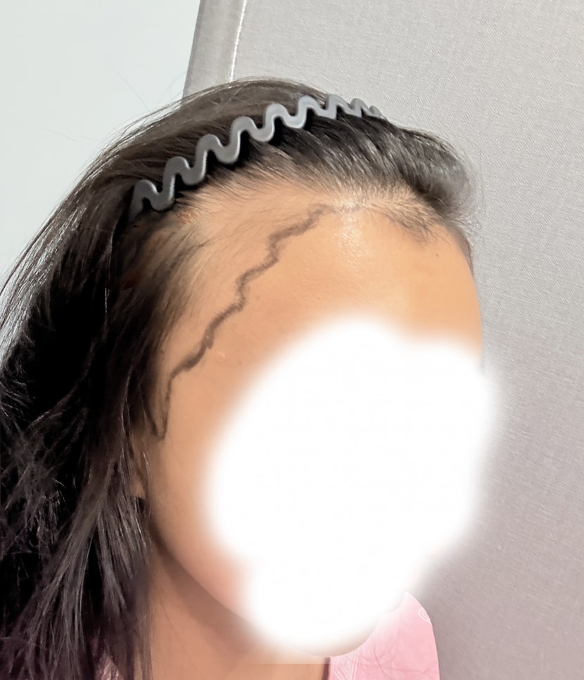 수술전 왼쪽 디자인