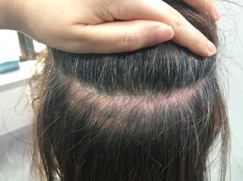 사진보다 심해요 특히 양쪽 끝부분은 흉터부위가 넓어요ㅜㅜ