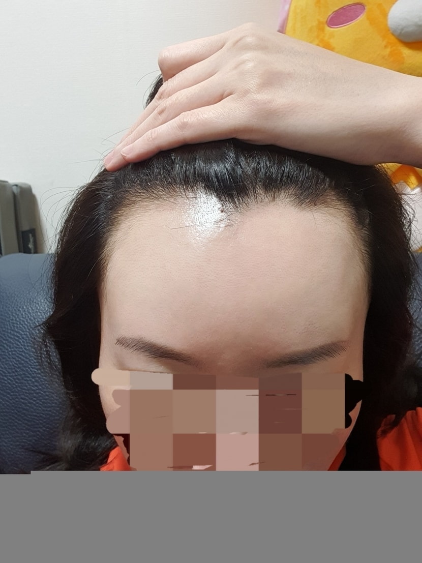 수술전