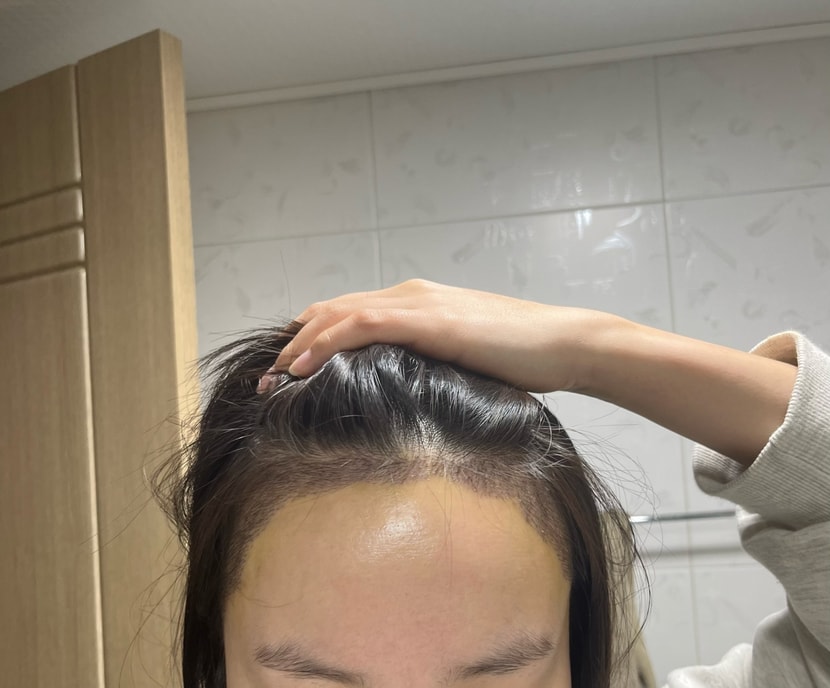 수술7일차