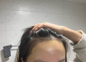 수술7일차