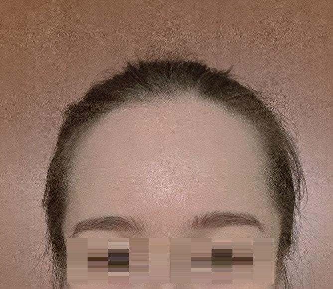 It's my first year of hairline hair transplant. It's settled down naturally