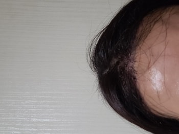 수술후 3일차 사진