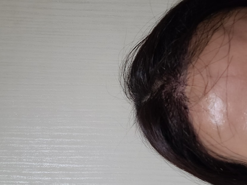 수술후 3일차 사진