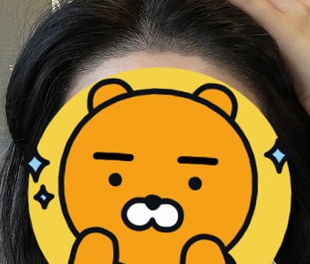 5/18 각질케어후. 각질제거 받고 많이 안 빠지는 것 같더니 어느순간부터 안빠졌어요!