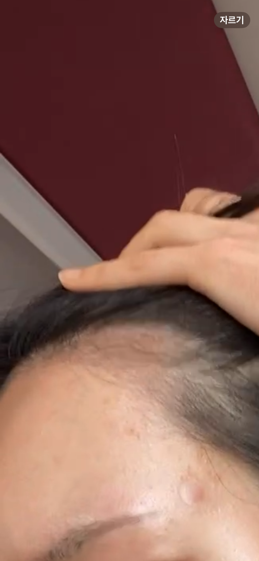 수술전