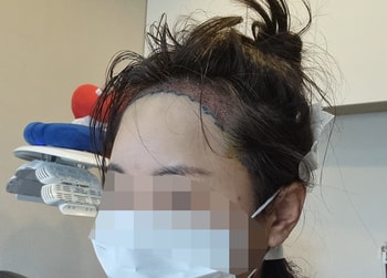 수술 끝나고 혼자 찍은 셀카
