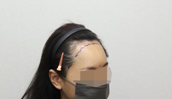 수술전