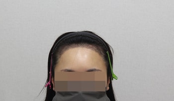 2주차/각질샴푸 받고 