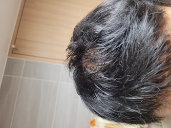 (샴푸후) 3.소이시딜 폼 바른 후 5분 경과 (건조됨)
