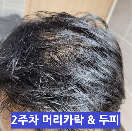 2주차 두피 사진