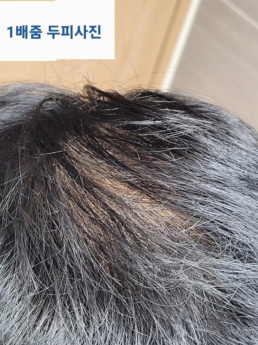 두피사진 1배줌