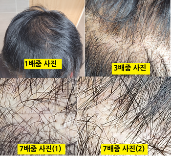 케어 직후 두피 사진 4장 (1배줌 - 3배줌 - 7배줌)