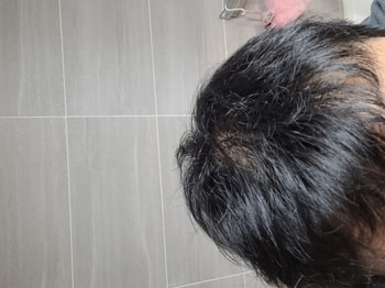 멀리서 찍은 두피 사진