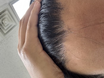 전면부 두피상태