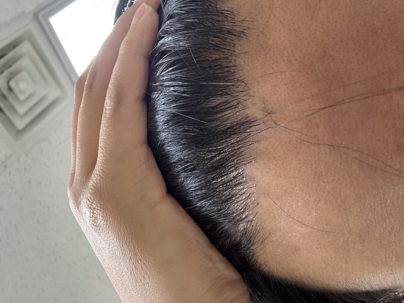 전면부 두피상태