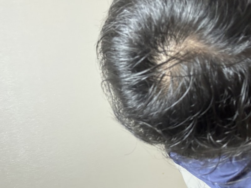 닥터포헤어 폴리젠 씨크닝 스칼프 세럼 2주차!!