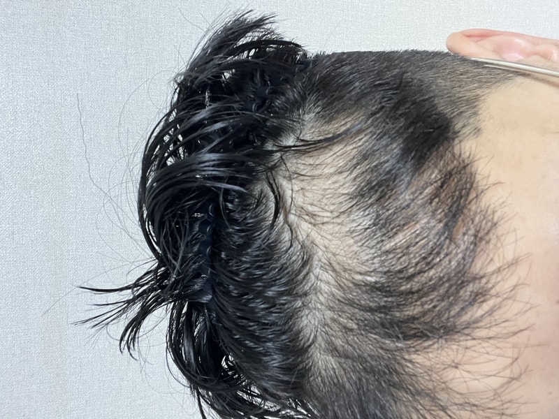 더마시모 2주차 후기